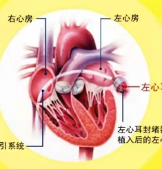 预防脑卒中，要做心脏介入手术吗？