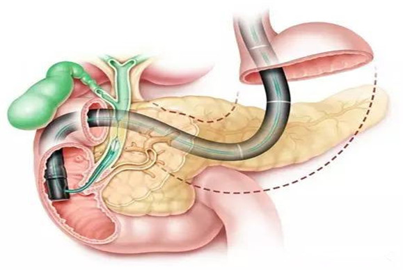 ERCP_副本.jpg